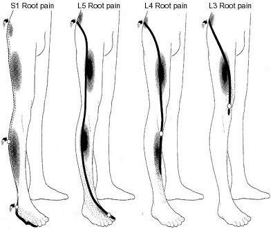 Sciatica Chart